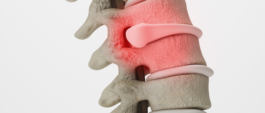 《退行性腰椎管狭窄症诊疗专家共识》解读