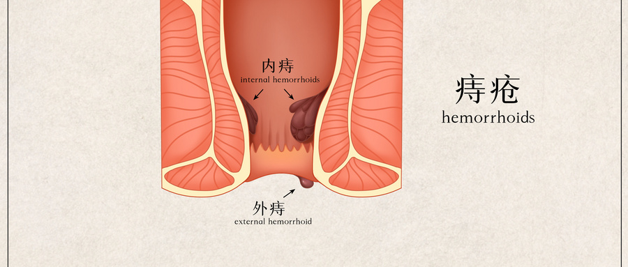 2024 ASCRS临床实践指南：痔疮的管理