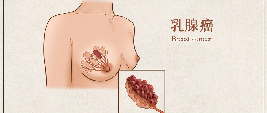 全球及中国乳腺癌的流行病学趋势及防控启示：2018–2022年《全球癌症统计报告》解读